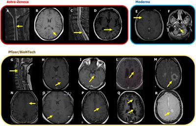 Case Report: Multiple Sclerosis Relapses After Vaccination Against SARS-CoV2: A Series of Clinical Cases